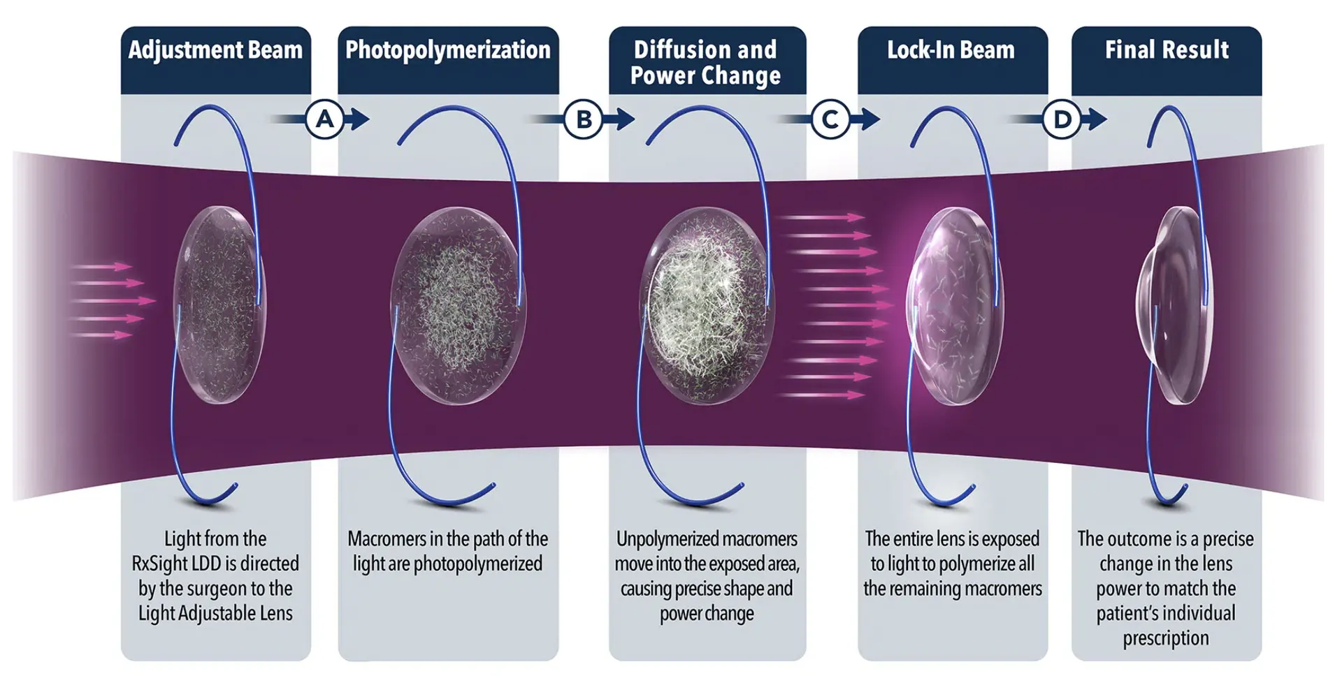 Light Adjustable Lens process — Adjustment Beam, Photopolymerization, Diffusion and Power Change, Lock-In Beam, Final Result
